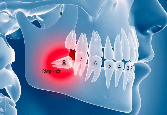 Răng khôn thường mọc khi bạn đã trưởng thành