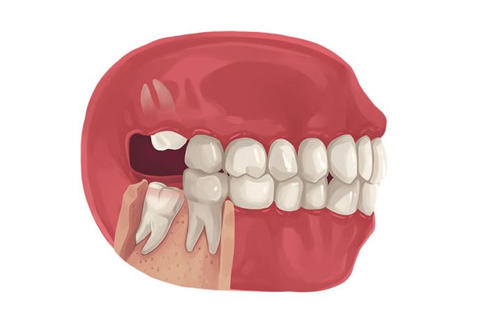 Răng khôn thường bị mọc lệch
