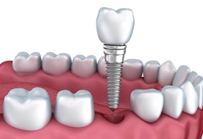 Thực hiện cấy ghép implant khi bị mất răng số 6