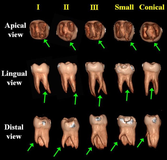 Số lượng chân của răng khôn là một câu hỏi phổ biến của nhiều người