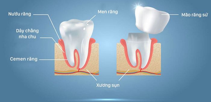 Tưởng tượng về kỹ thuật bọc răng sứ