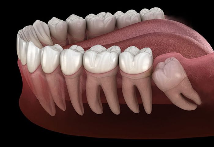 Răng khôn bị kẹt trong nướu