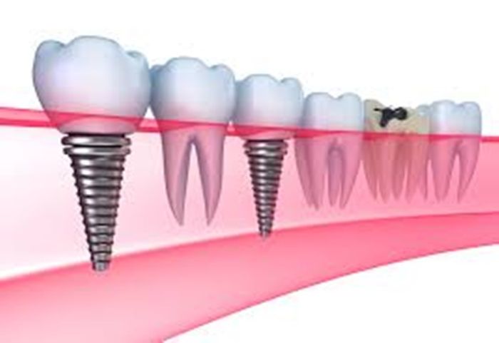 Cấy ghép Implant là cách sử dụng chân răng giả để thay thế cho răng thật bị mất bằng cách cấy ghép vào xương hàm.