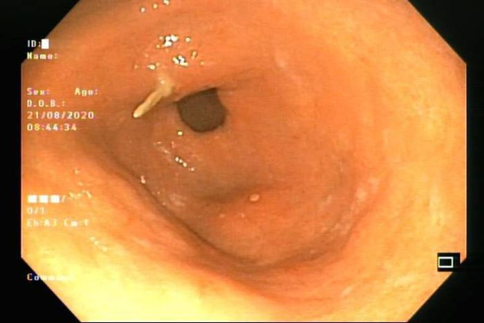 Hình ảnh từ nội soi cho thấy mảnh xương cá đâm xuyên qua thành dạ dày.