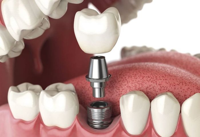 Cấy ghép Implant là phương pháp hữu ích để thay thế những chiếc răng bị mất hoặc hư hại mà không kém cạnh những chiếc răng tự nhiên