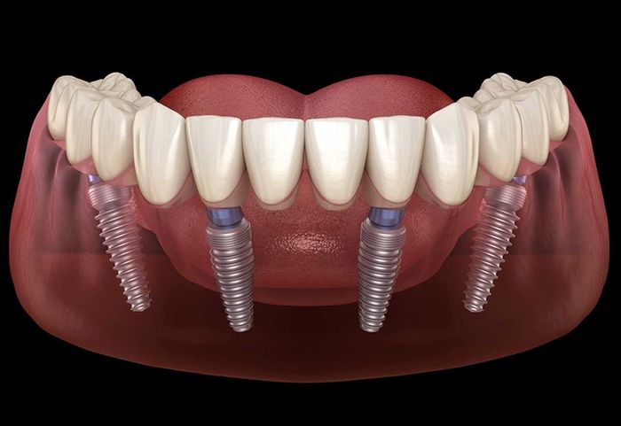 Việc thực hiện Implant All On 4 cần phải được thực hiện trên các trang thiết bị hiện đại.