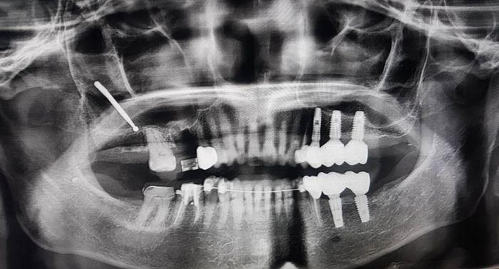 Vết thương xuyên và vết thương do hỏa khí có thể gây ra vấn đề về hàm mặt.