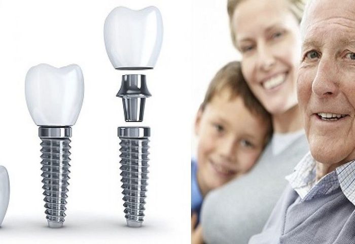 Nếu được chăm sóc đúng cách, tuổi thọ của răng Implant có thể kéo dài rất lâu