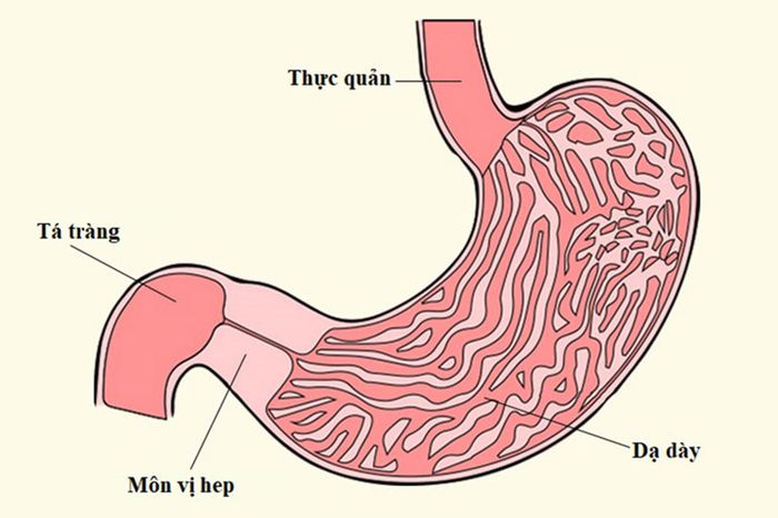 Hình minh họa khi cơ môn vị trở nên dày làm hẹp van giữa dạ dày và ruột non