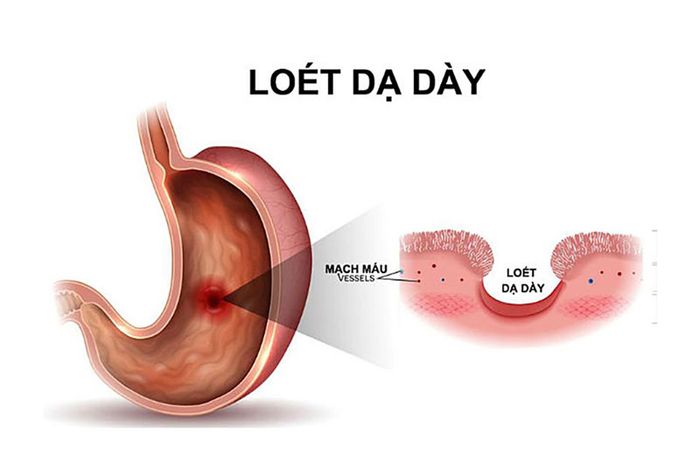 Hình minh họa về bệnh loét dạ dày