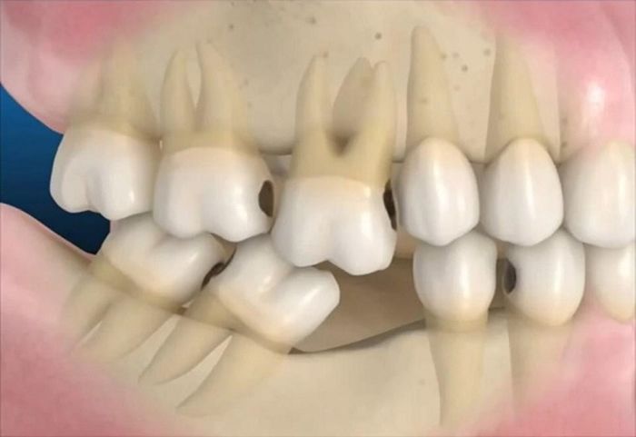 Cấy ghép Implant All On 4 ngăn ngừa tiêu xương răng