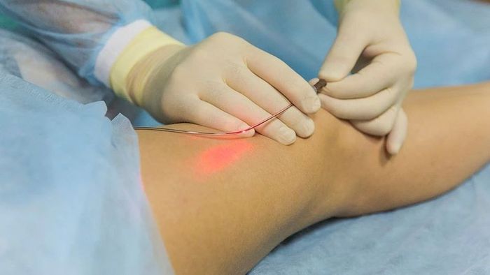 Phương Pháp Laser Nội Mạch: Hiệu Quả và Phục Hồi Nhanh