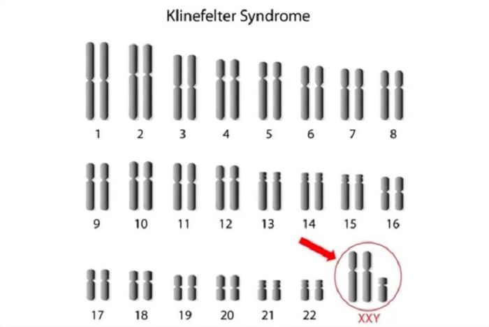 Hội chứng Klinefelter phát sinh ở bé trai ngay từ khi chào đời với một nhiễm sắc thể X dư thừa