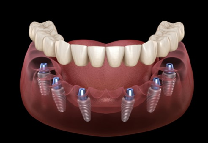 Việc cấy ghép răng implant toàn hàm giúp ngăn ngừa các biến chứng có thể xảy ra do mất răng