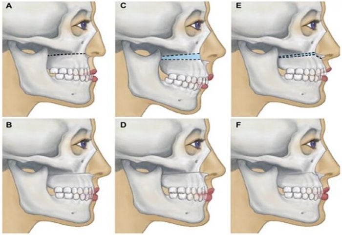 Phẫu thuật chỉnh hàm hô giúp nhiều người bệnh lấy lại sự tự tin.