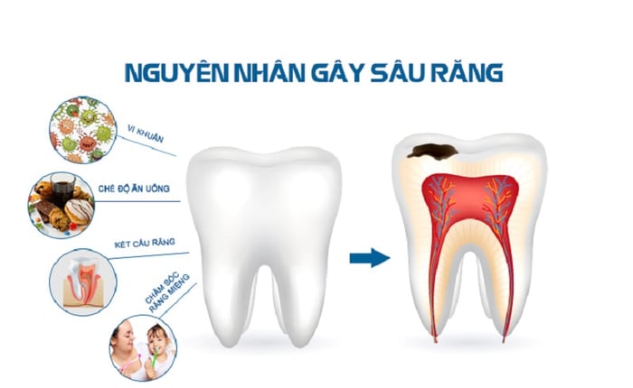 Răng hàm dễ bị sâu do nhiều yếu tố khác nhau