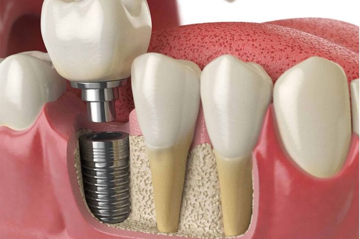 Chất liệu làm trụ Implant tương thích tốt với xương hàm