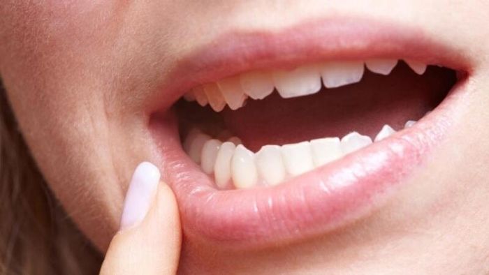Nhiệt lưỡi thường là kết quả của việc cắn vào lưỡi gây tổn thương