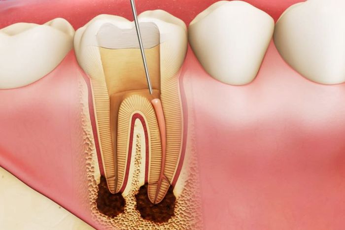 Chữa tủy răng có đau không?