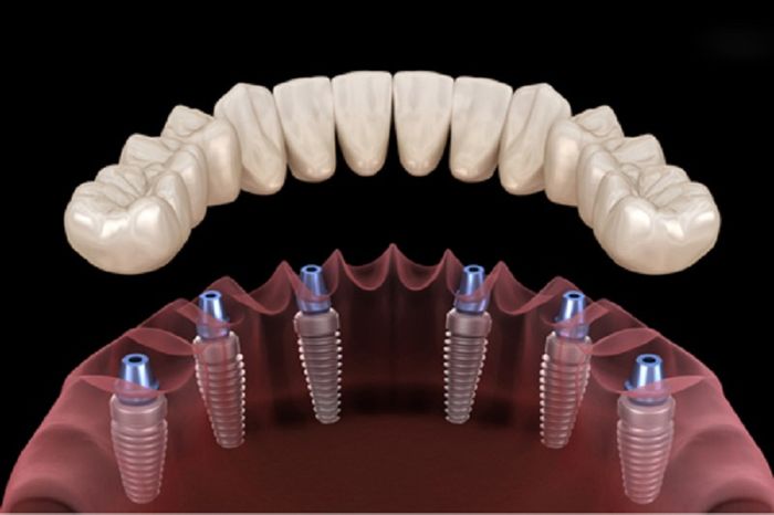 Việc phục hồi toàn bộ hàm răng với ít trụ Implant sẽ bảo đảm sức khỏe cho người bệnh