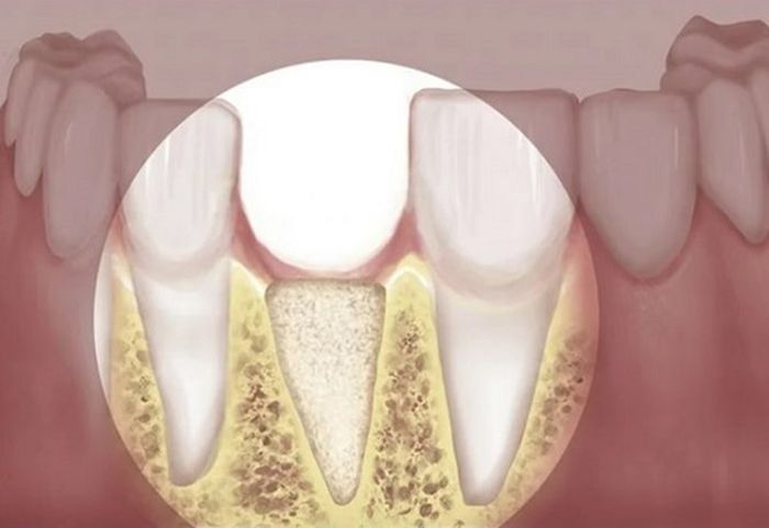 Tiêu hao xương ổ răng gây ra nhiều hậu quả nghiêm trọng