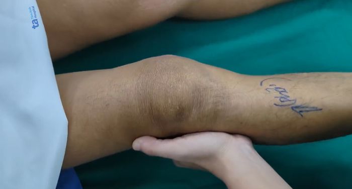 Sau cú ngã từ xe, dây chằng và khớp gối bị tổn thương