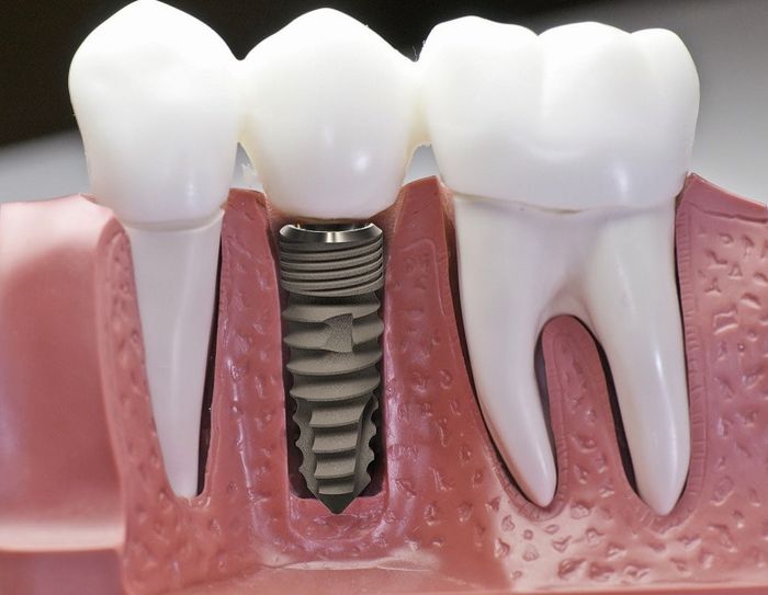 Cấy ghép Implant là phương pháp tạo ra răng giả thay thế tại vị trí răng đã mất.