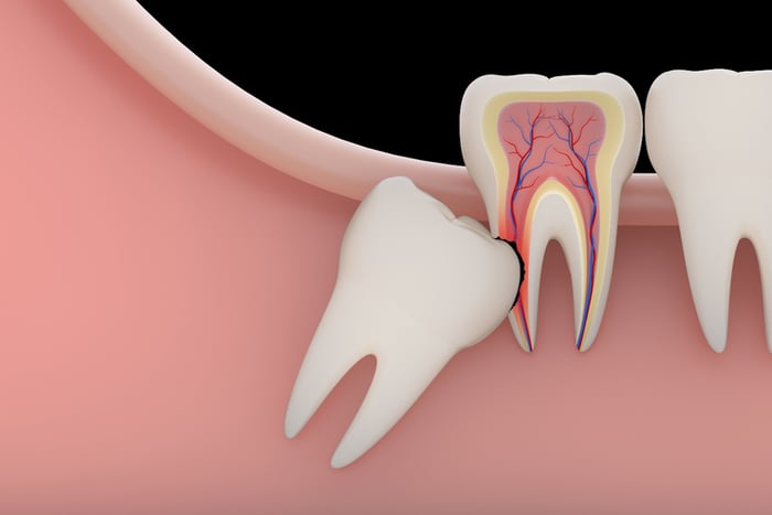 Răng khôn mọc có thể gây tổn thương cho răng bên cạnh