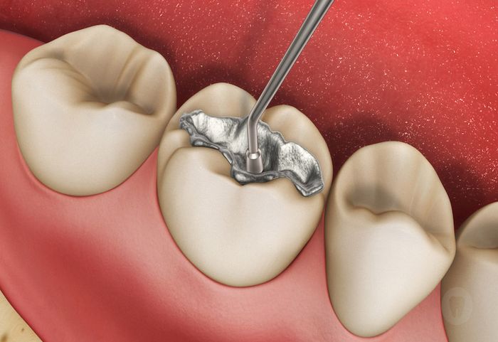 Tránh ăn uống các thực phẩm có màu sắc, nước ngọt, cà phê, hoặc hút thuốc lá để tránh làm xỉn màu miếng hàn. Không được xỉa hoặc tác động vào vùng răng hàn bằng vật cứng.