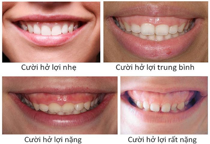 Các cấp độ khi cười để lộ nướu