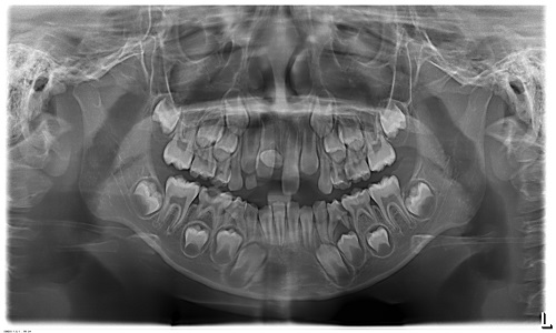 Hình ảnh chụp Panorama cho thấy răng thừa mọc ngầm ở hàm trên của bệnh nhân