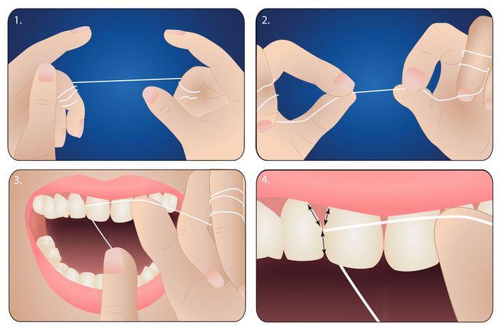 Các bước sử dụng chỉ nha khoa