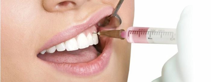 Tiêm botox trong việc điều trị tình trạng cười hở lợi