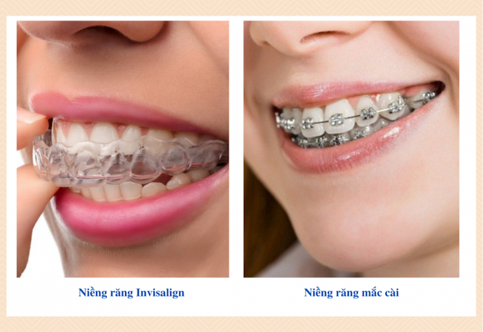 Niềng răng trong suốt Invisalign mang lại tính thẩm mỹ cao hơn so với niềng răng mắc cài