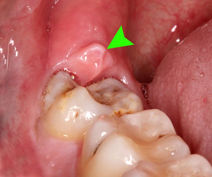 Răng khôn nếu không được vệ sinh sạch sẽ có thể gây ra viêm nướu