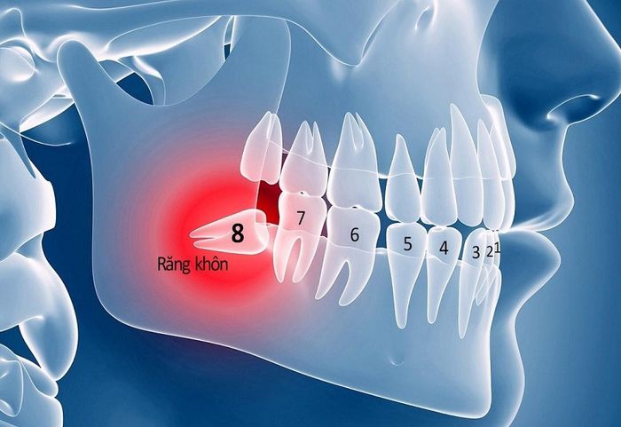 Răng khôn mọc lệch tạo ra nhiều hậu quả xấu cho sức khỏe