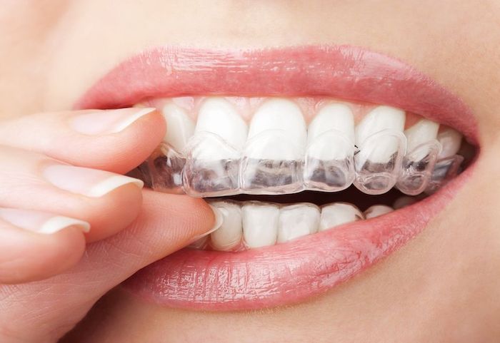 Niềng răng trong suốt Invisalign cũng là phương pháp được áp dụng trong các trường hợp khớp cắn ngược