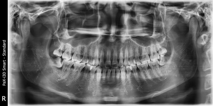 Bác sĩ cần kiểm tra cấu trúc và vị trí của răng khôn trước khi thực hiện nhổ