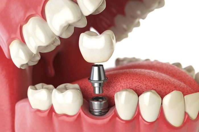 Chọn loại trụ Implant phù hợp sẽ giúp bạn phục hồi hình răng nhanh chóng và giảm thời gian chờ đợi tích hợp giữa xương hàm và trụ