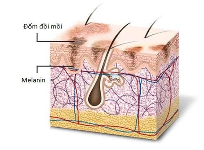 Tích tụ melanin quá mức tạo ra các vết sậm màu trên da