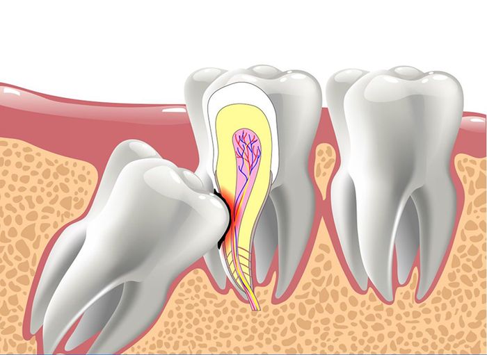 Tình trạng răng khôn ảnh hưởng đến thời gian lành sau khi nhổ răng khôn