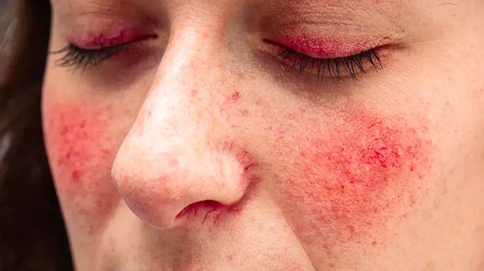 Dấu hiệu tiêu biểu của Rosacea là da mặt bị đỏ