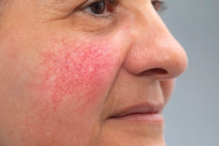 Nhiều yếu tố khác cũng được cho là có liên quan đến Rosacea