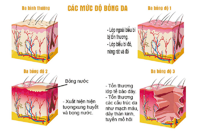 Mức độ tổn thương theo cấp độ bỏng