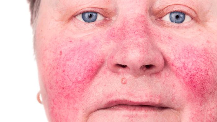 Da mặt ửng hồng - biểu hiện đặc trưng của hội chứng Rosacea