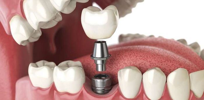 Cấy ghép implant là phương pháp trồng răng có nhiều ưu điểm.