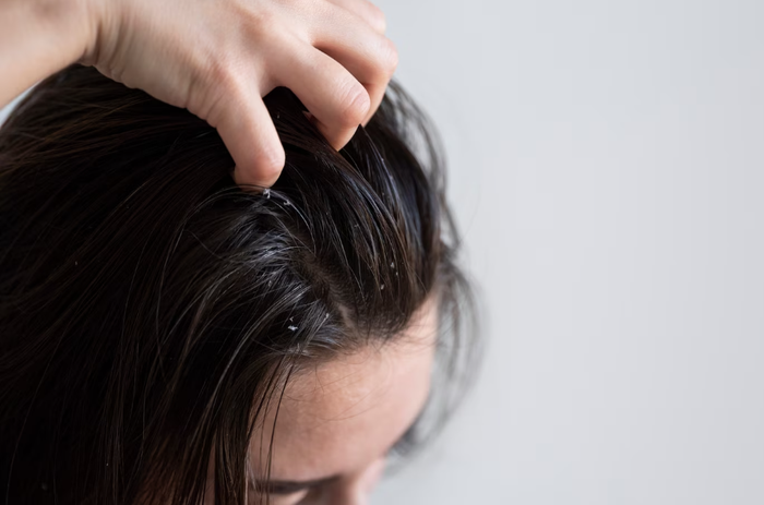 Da đầu dầu gây ra cảm giác khó chịu và tạo ra nhiều gàu