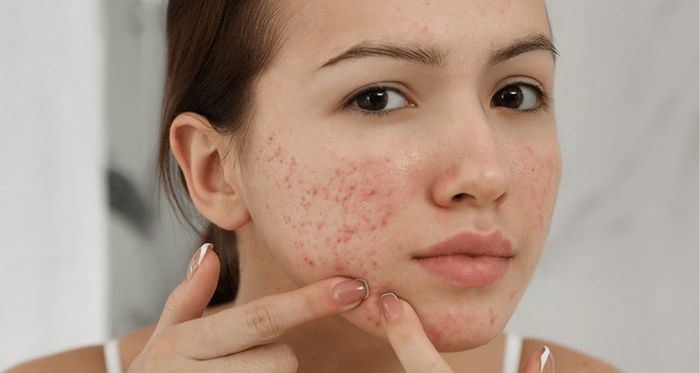 Mụn trứng cá có thể xuất phát từ nhiều nguyên nhân như nội tiết tố, dinh dưỡng, mỹ phẩm, và vệ sinh