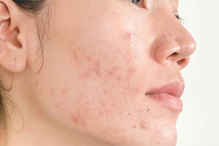 Serum với thành phần kháng khuẩn và kiềm dầu hỗ trợ hiệu quả cho làn da dầu mụn