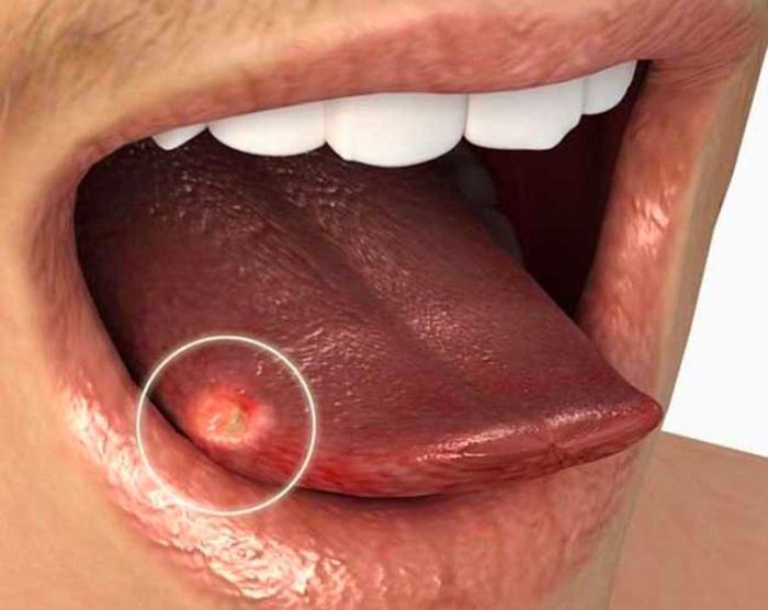 /Những nốt mụn thịt trắng trên lưỡi của bệnh u nang bạch huyết